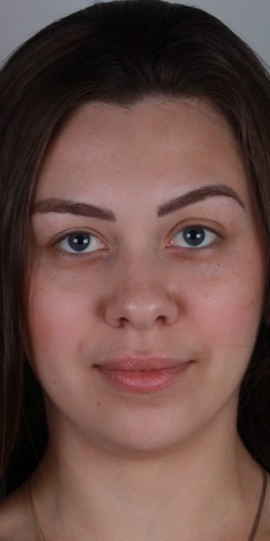 Antes: Botox