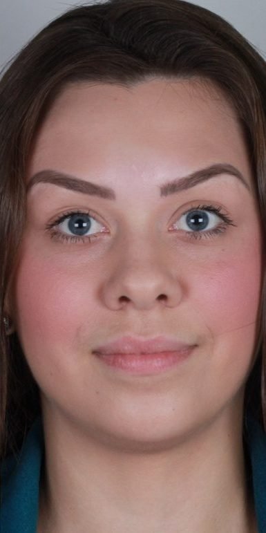 Depois: Botox