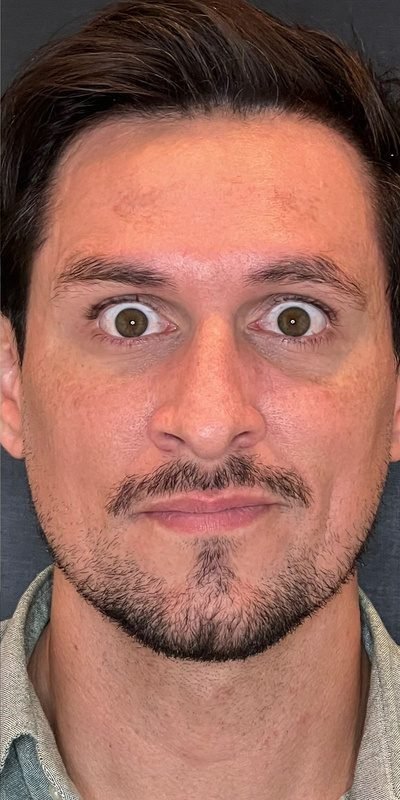 Depois: Botox masculino