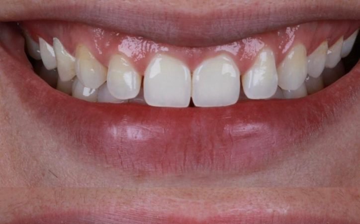 Antes: Fechamento de diastema