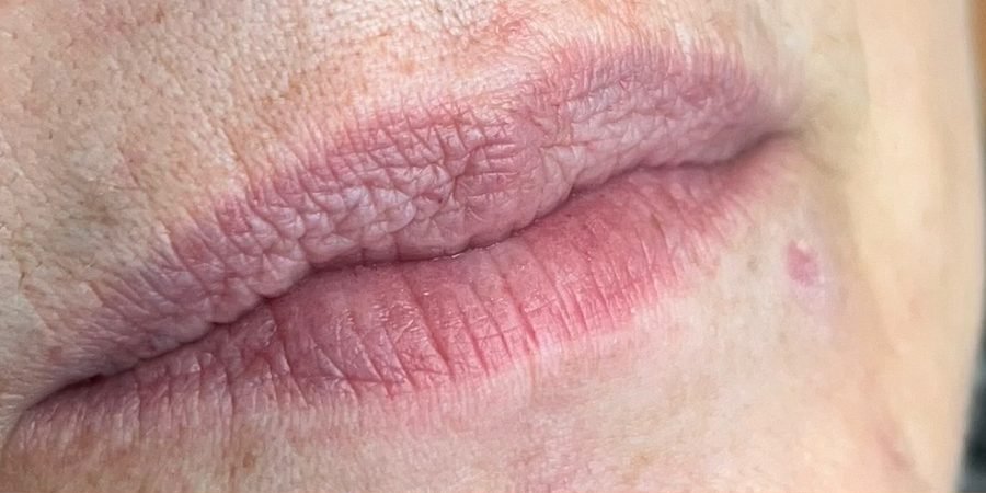 Antes: Preenchimento labial