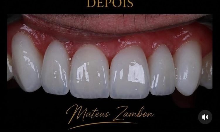 Depois: Lentes de porcelana