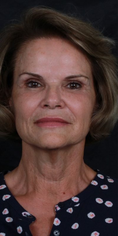 Antes: Lifting facial