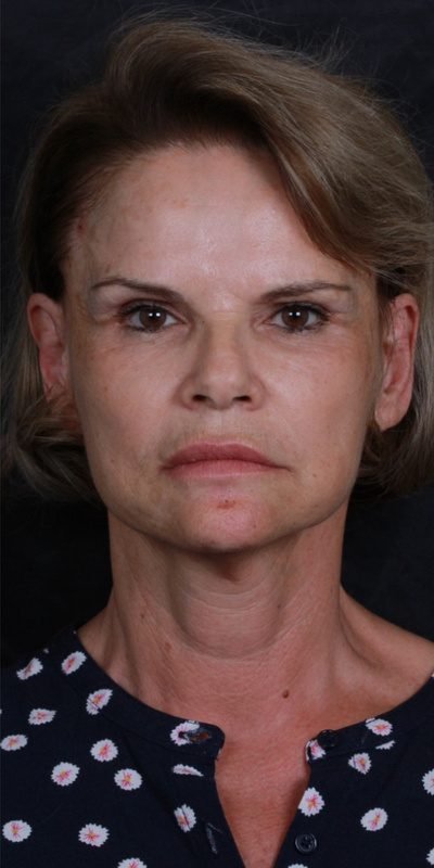 Depois: Lifting facial
