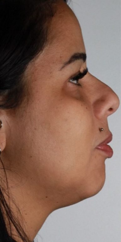 Antes: Lipo de papada