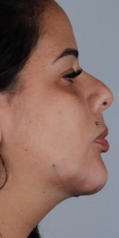 Depois: Lipo de papada